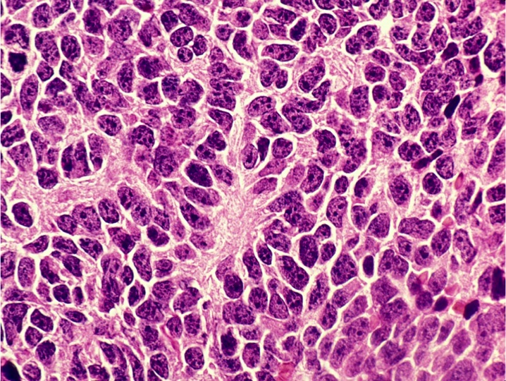 Trovata una nuova cura contro il medulloblastoma