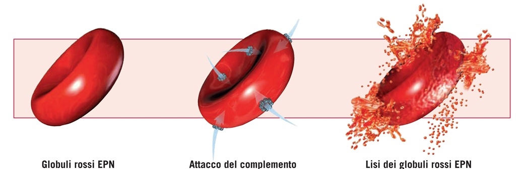 Erasmus in Spagna nonostante la sua malattia rara, al farmaco per curarsi pensa la ASL Lecce