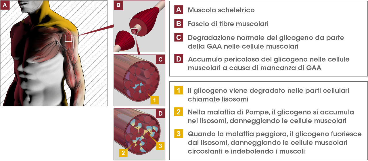 Malattia di Pompe, passi avanti nella sua conoscenza Malattia di Pompe, passi avanti nella sua conoscenza