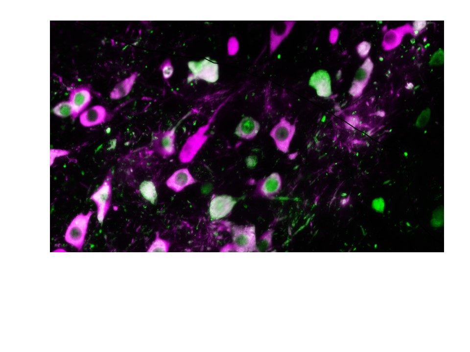  Fasi iniziali della malattia di Parkinson, scoperta un'alterazione del cervello