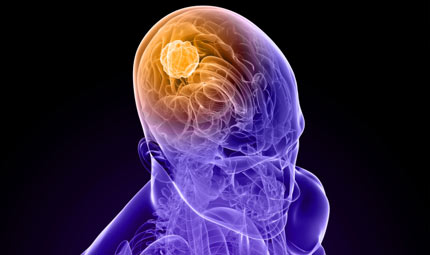 Le neoplasie del sistema nervoso in parole semplici