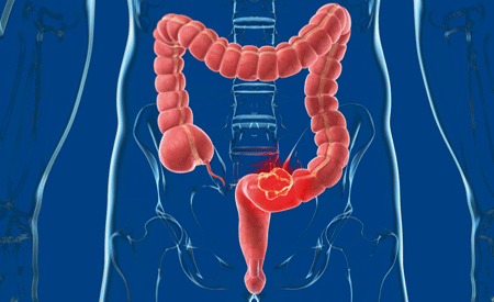 Il gene SMC1A può portare ad una diagnosi precoce del tumore al colon-retto Il gene SMC1A può portare ad una diagnosi precoce del tumore al colon-retto