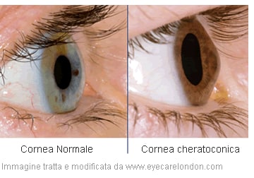 Al via la campagna di prevenzione e diagnosi del Cheratocono