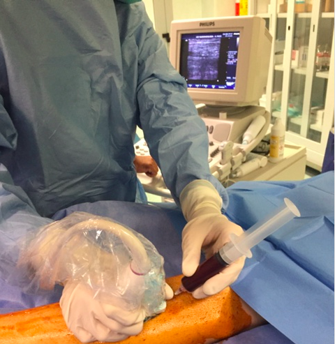 Il piede diabetico curato a Lecce con un autotrapianto di cellule staminali