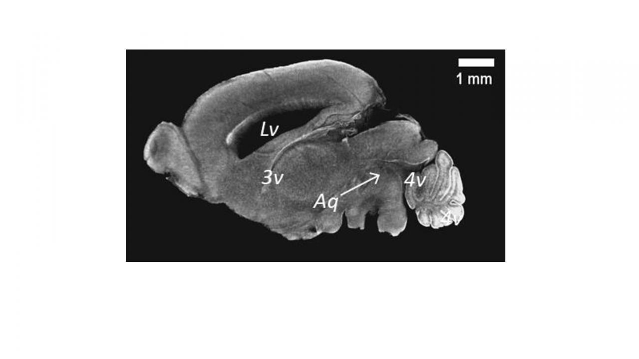 Ciliopatia, la causa è un gene alterato