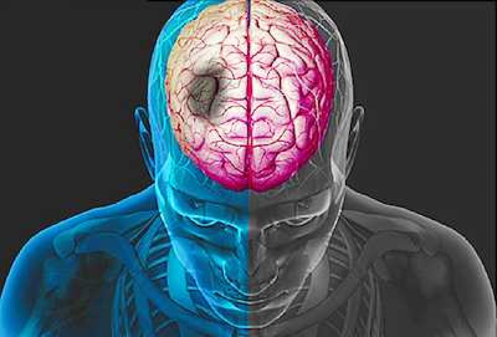 Nuova luce sulla riabilitazione dopo un ictus Nuova luce sulla riabilitazione dopo un ictus