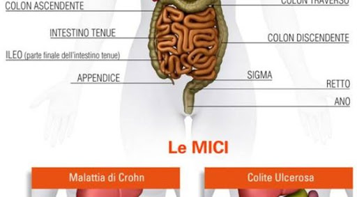 “Le MICI in ambito pediatrico. Un confronto con l'Ospedale Casa Sollievo della Sofferenza" “Le MICI in ambito pediatrico. Un confronto con l'Ospedale Casa Sollievo della Sofferenza"