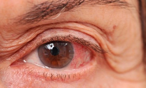 Per combattere il glaucoma (ladro silenzioso della vista) visite gratuite a Lecce e Copertino