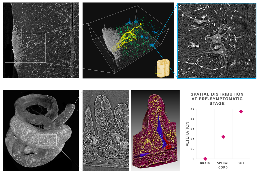 Capire le malattie neurodegenerative con i raggi X Capire le malattie neurodegenerative con i raggi X