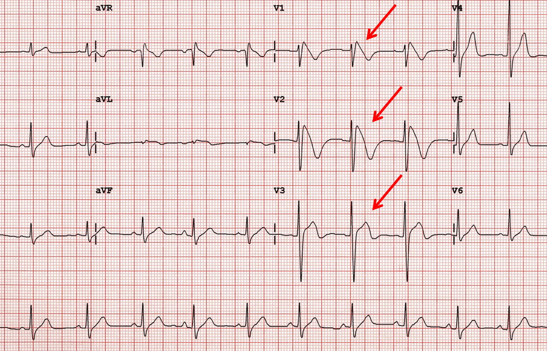 Passi avanti nella conoscenza di un'asintomatica malattia cardiaca, la sindrome di Brugada