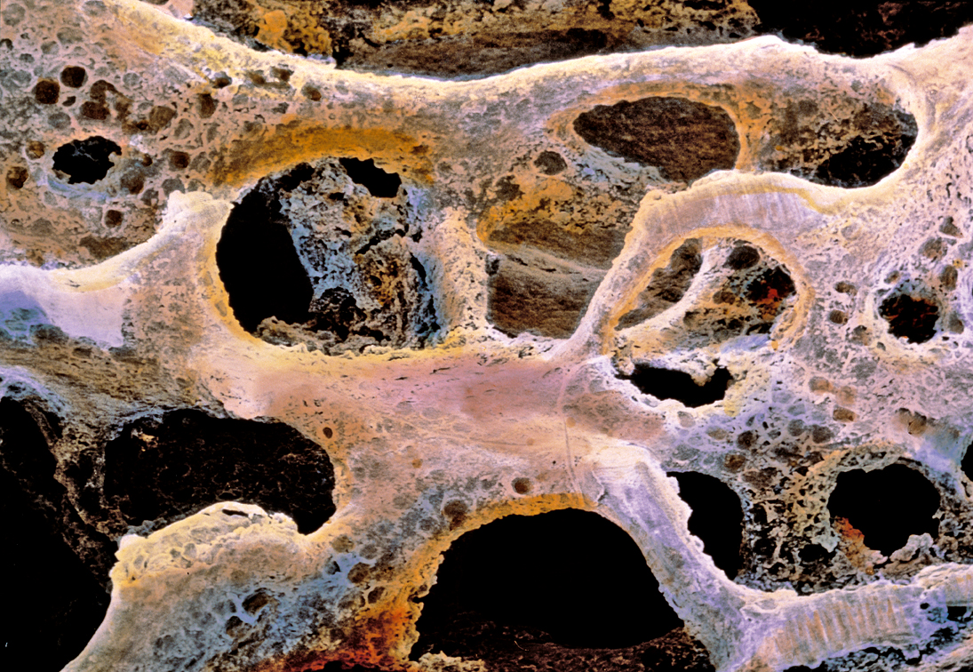 Rischio osteoporosi, controllo gratuito l'8 marzo