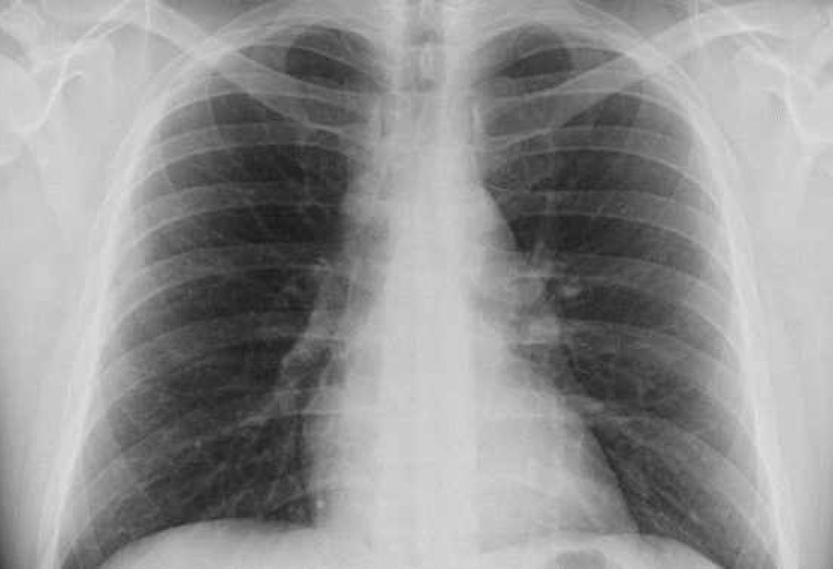 Nessun caso di meningite al Pronto Soccorso di Gallipoli