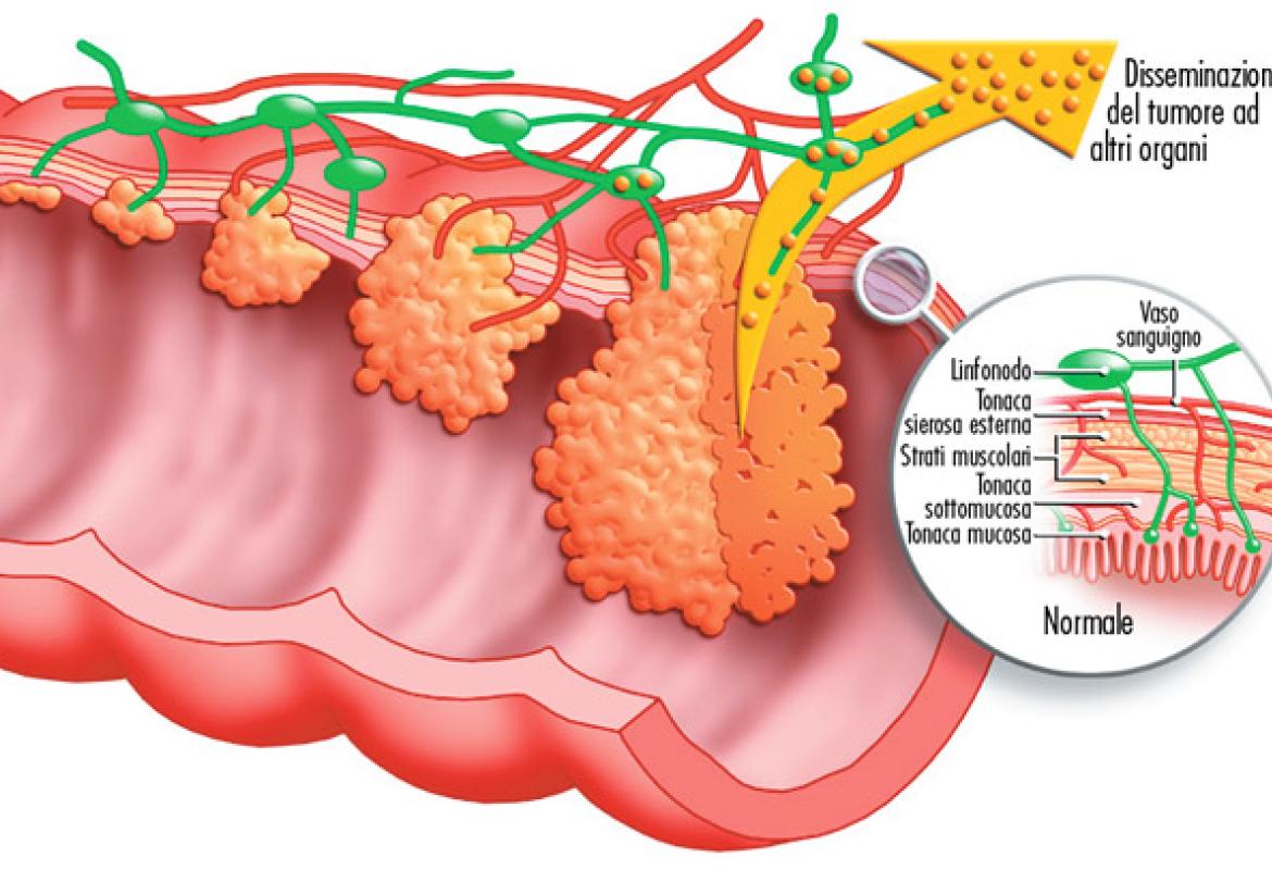 Nuove speranze per i malati di carcinoma colorettale