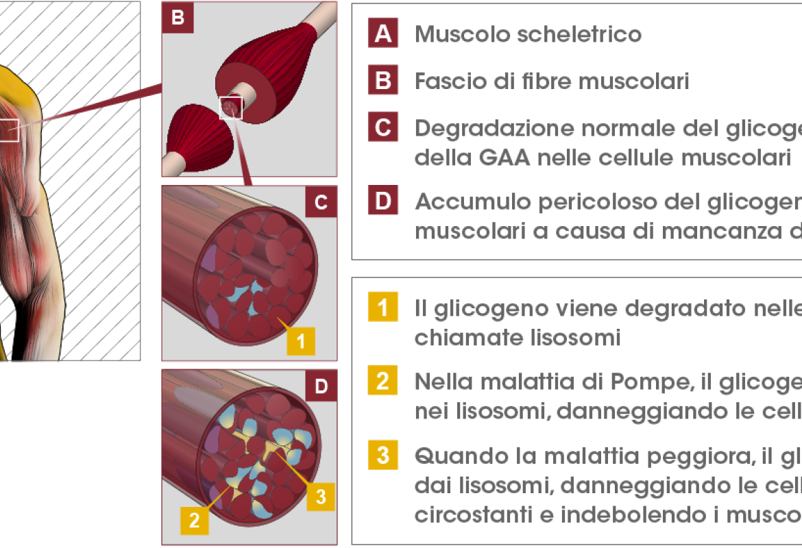 Malattia di Pompe, passi avanti nella sua conoscenza