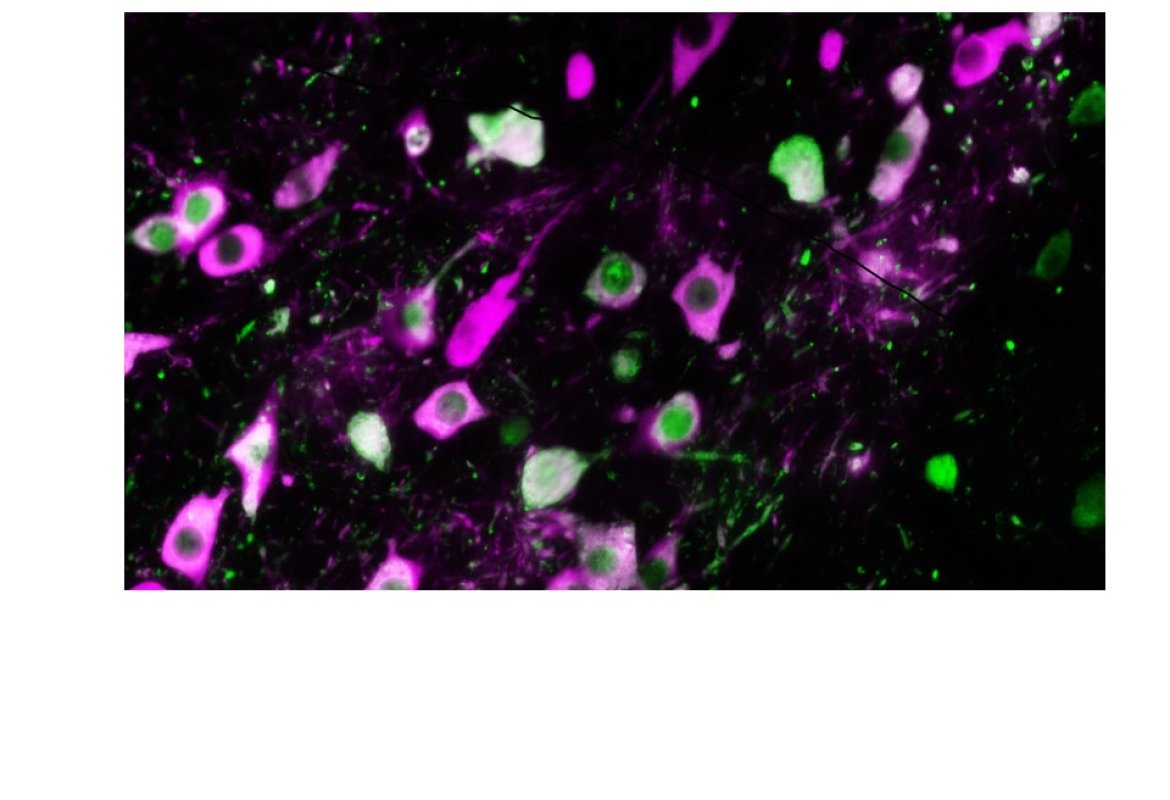  Fasi iniziali della malattia di Parkinson, scoperta un'alterazione del cervello