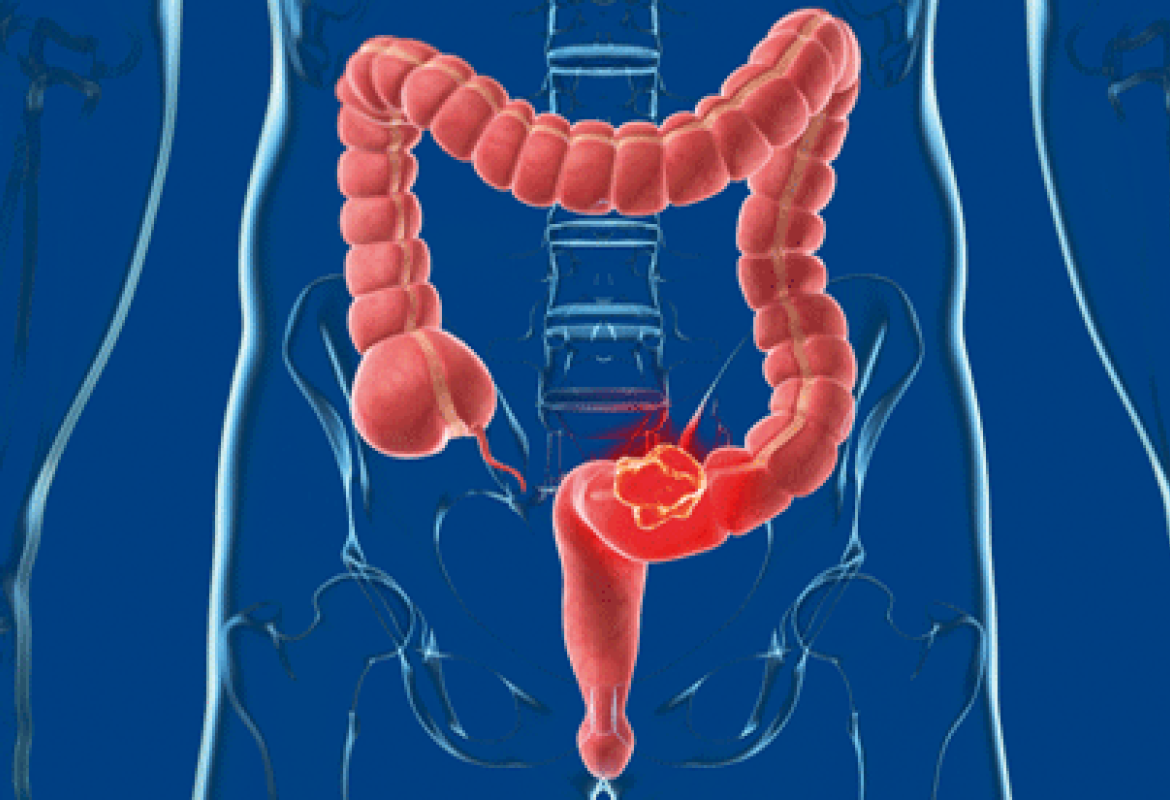 Il gene SMC1A può portare ad una diagnosi precoce del tumore al colon-retto
