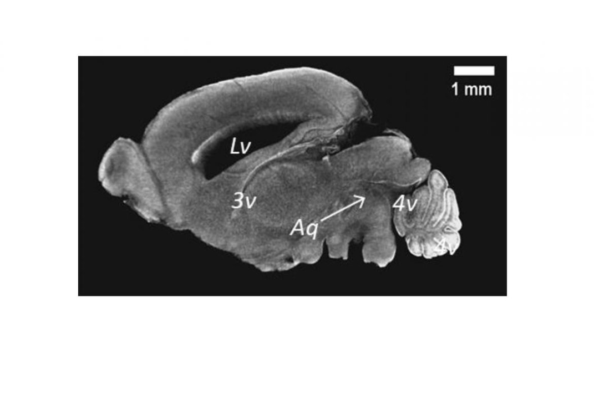 Ciliopatia, la causa è un gene alterato