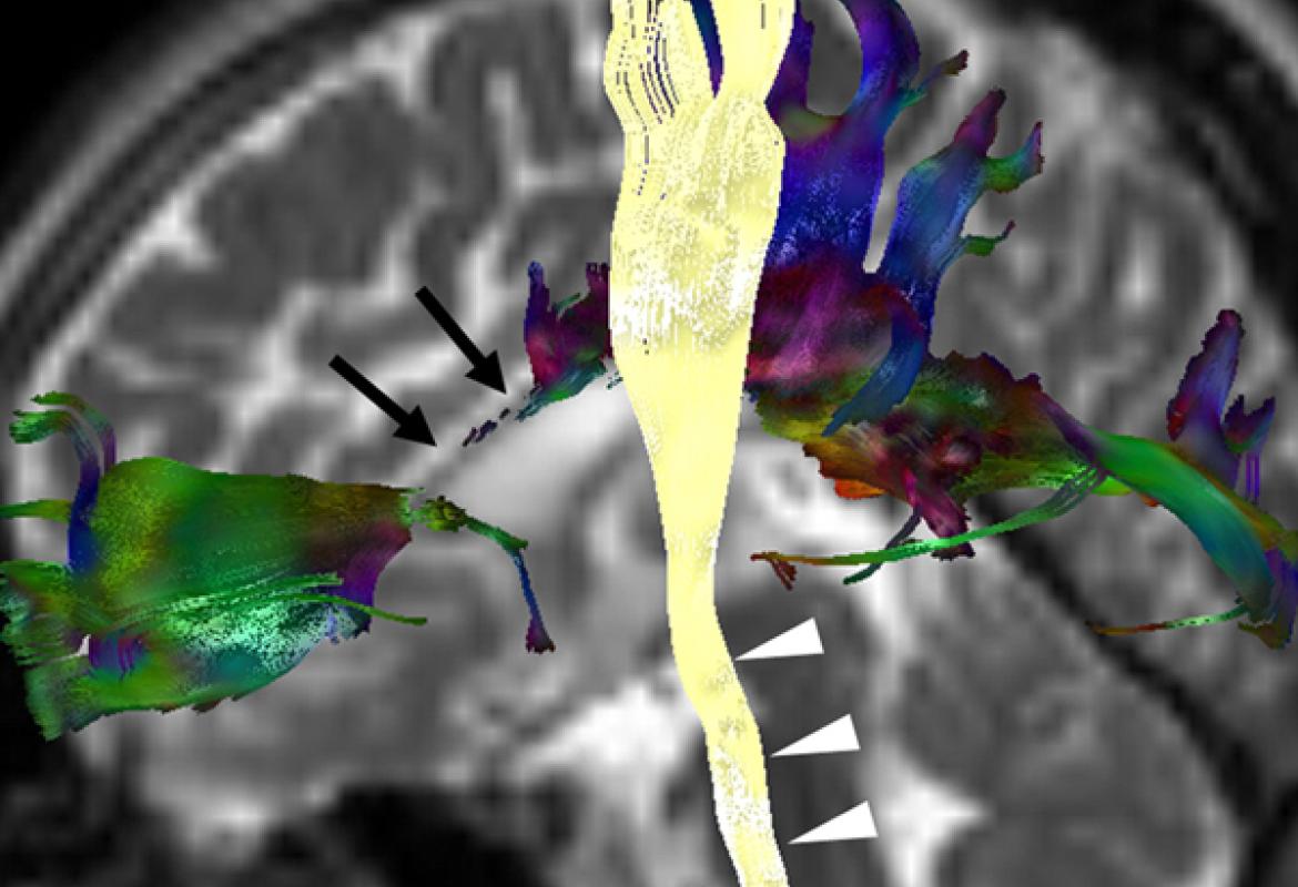 Un nuovo promettente approccio terapeutico per la paraplegia spastica ereditaria