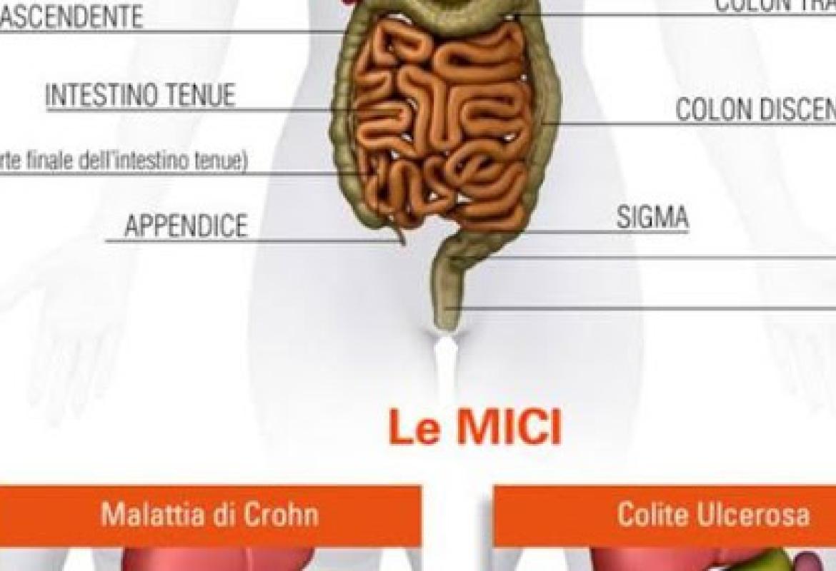 “Le MICI in ambito pediatrico. Un confronto con l'Ospedale Casa Sollievo della Sofferenza&quot;
