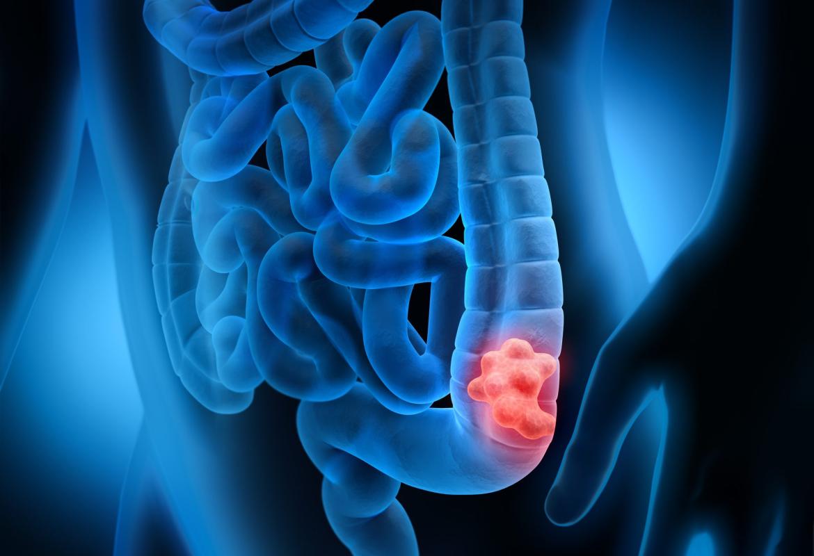 Le nanotecnologie per contrastare il tumore al colon