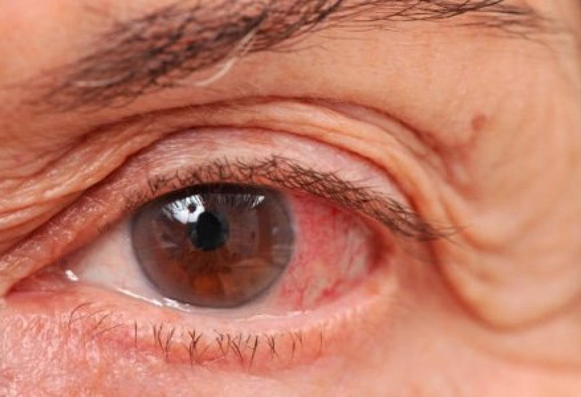 Per combattere il glaucoma (ladro silenzioso della vista) visite gratuite a Lecce e Copertino