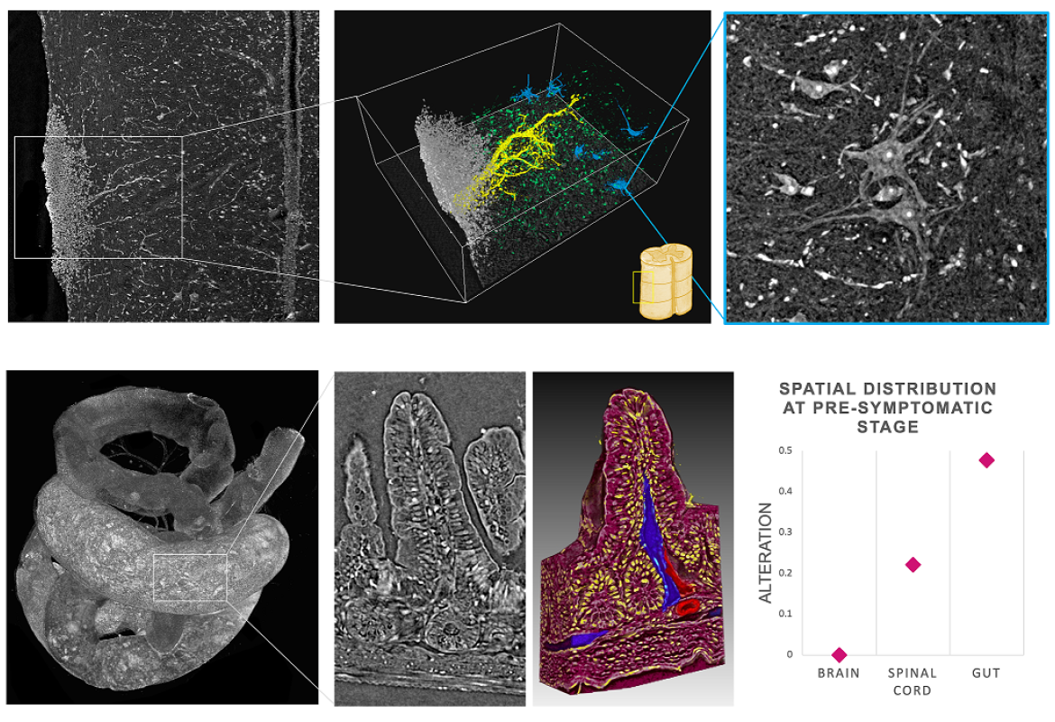 Capire le malattie neurodegenerative con i raggi X