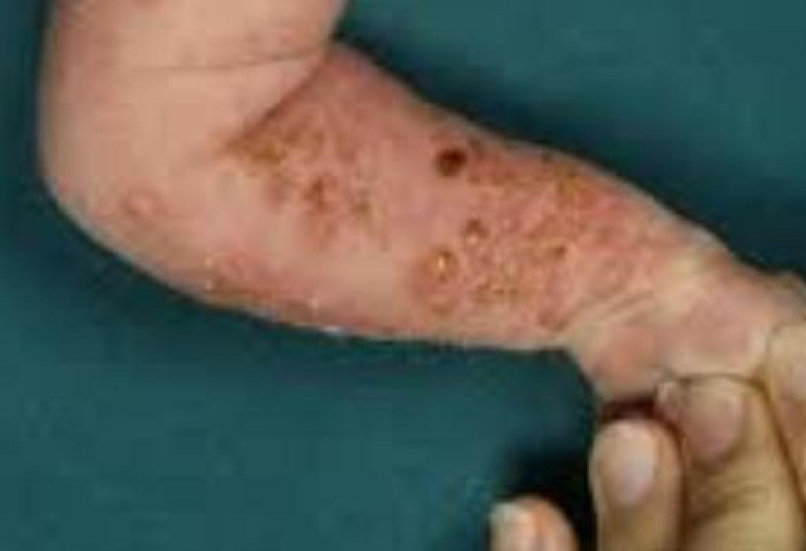 Il gene 'Nemo' può causare disturbi dell'apprendimento