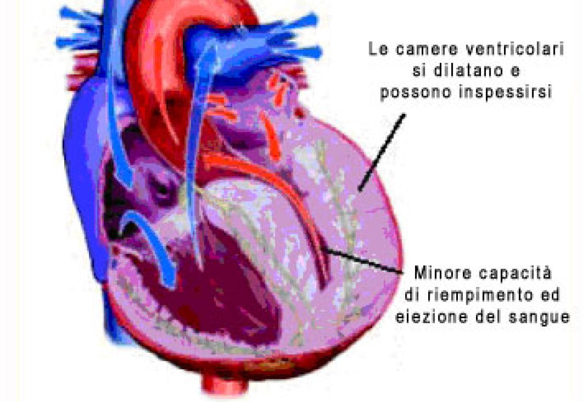 Il Sole 24 ore: "Nella Asl di Lecce curano bene lo scompenso cardiaco e fanno risparmiare"