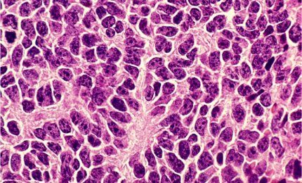 Trovata una nuova cura contro il medulloblastoma