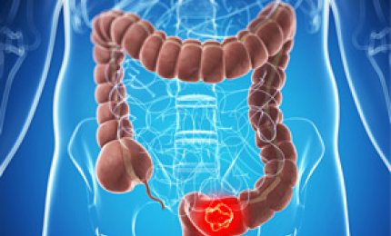 Stanziati due milioni e mezzo di euro per la prevenzione del tumore al colon-retto