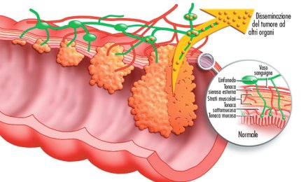 Nuove speranze per i malati di carcinoma colorettale