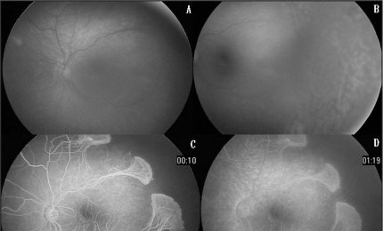 Anche il padre può trasmettere l'incontinentia pigmenti