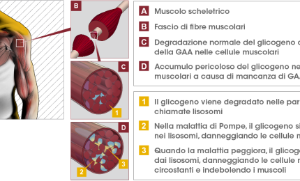 Malattia di Pompe, passi avanti nella sua conoscenza