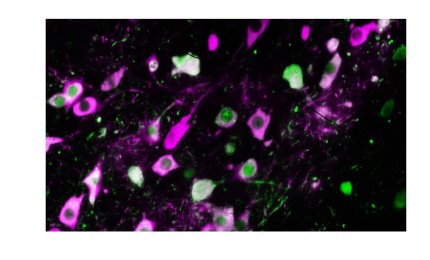  Fasi iniziali della malattia di Parkinson, scoperta un'alterazione del cervello