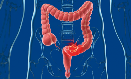 Il gene SMC1A può portare ad una diagnosi precoce del tumore al colon-retto