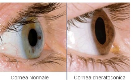 Al via la campagna di prevenzione e diagnosi del Cheratocono