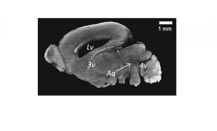 Ciliopatia, la causa è un gene alterato