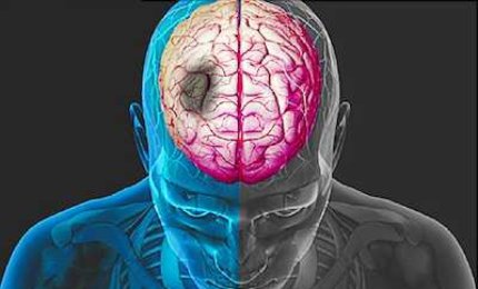 Nuova luce sulla riabilitazione dopo un ictus