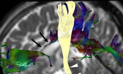 Un nuovo promettente approccio terapeutico per la paraplegia spastica ereditaria