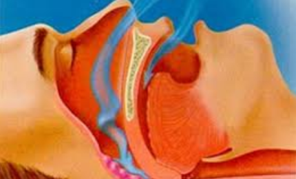 Nuove linee guida per la sindrome delle apnee ostruttive nel sonno (OSA)