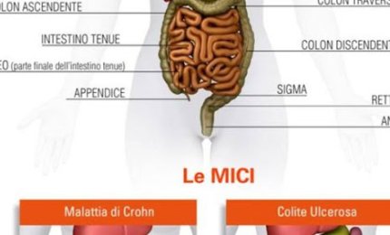 “Le MICI in ambito pediatrico. Un confronto con l'Ospedale Casa Sollievo della Sofferenza"