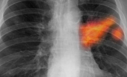 Tumore al polmone, lo studio su un nuovo farmaco 