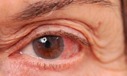 Per combattere il glaucoma (ladro silenzioso della vista) visite gratuite a Lecce e Copertino