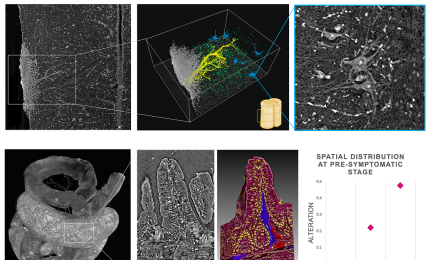 Capire le malattie neurodegenerative con i raggi X
