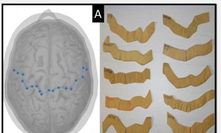 Sclerosi multipla, sarà possibile combattere la stanchezza cronica