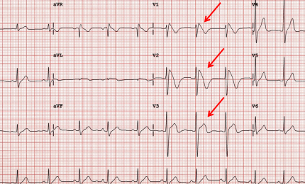 Passi avanti nella conoscenza di un'asintomatica malattia cardiaca, la sindrome di Brugada