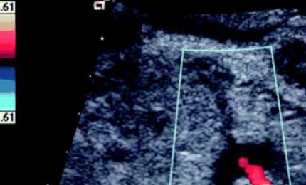 Galatina nella rete dei laboratori di ecografia cardiologica