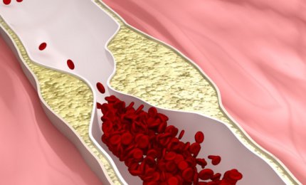  La recidiva del carcinoma prostatico spiegata dalla matematica