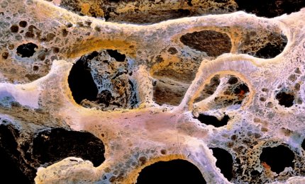 Rischio osteoporosi, controllo gratuito l'8 marzo
