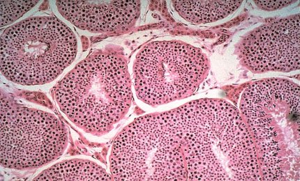 Tumore alla prostata: come migliorare la qualità della vita dei pazienti